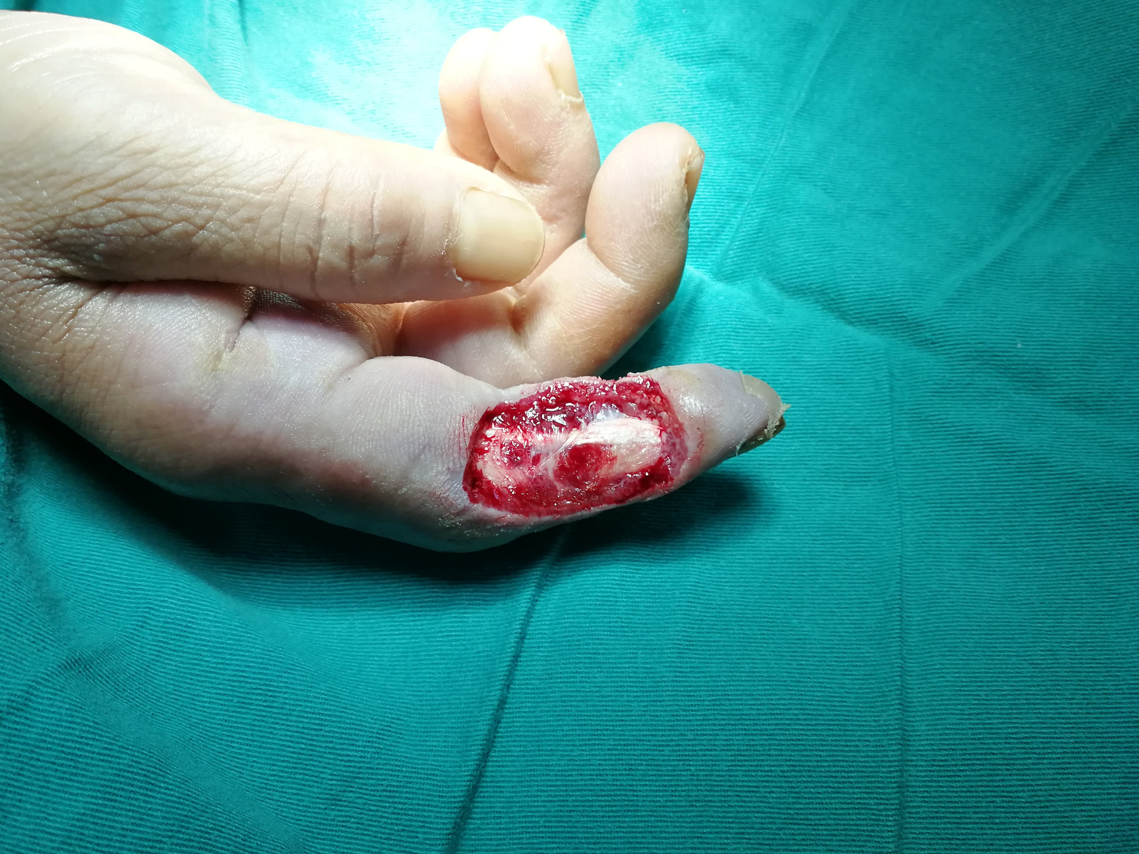 骨间背动脉穿支皮瓣修复手指皮肤软组织缺损的治疗 