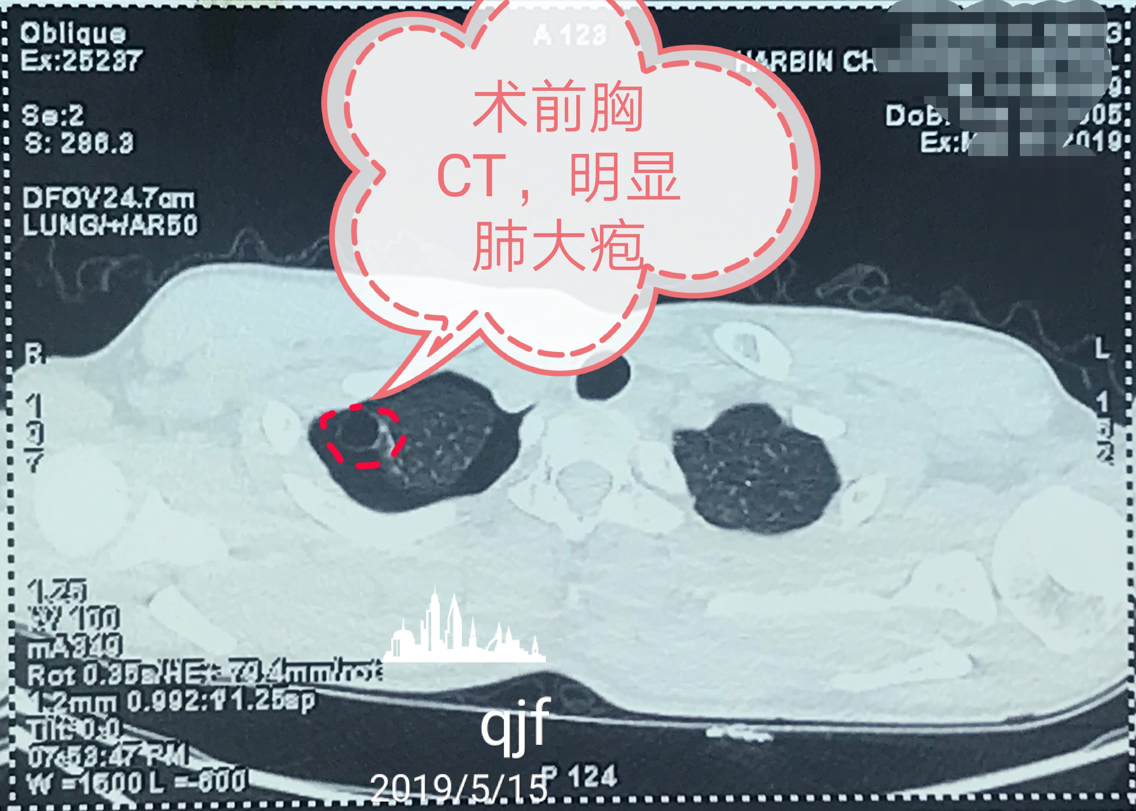 较小的,数目少的单纯肺大疱可无任何症状,有时只是在胸片或ct检查时