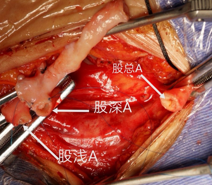股动脉瘤经典外科手术治疗 - 好大夫在线