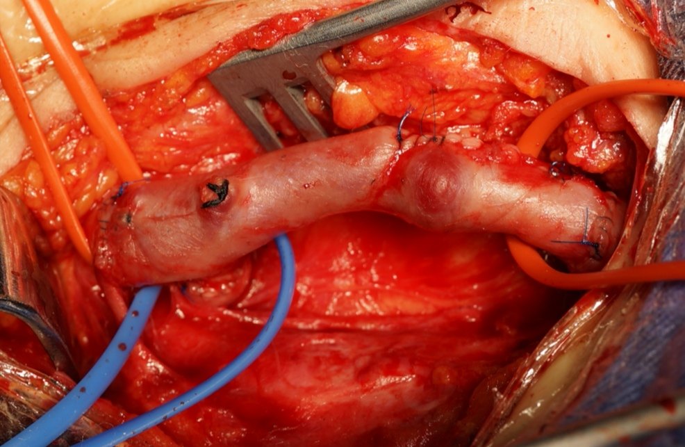 股动脉瘤经典外科手术治疗 - 好大夫在线