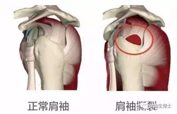 臨床工作中所說的肩袖,絕大多數指的是岡上肌損傷,岡上肌是最容易撕裂