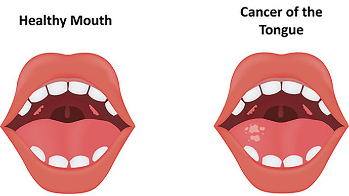 舌 癌 初期