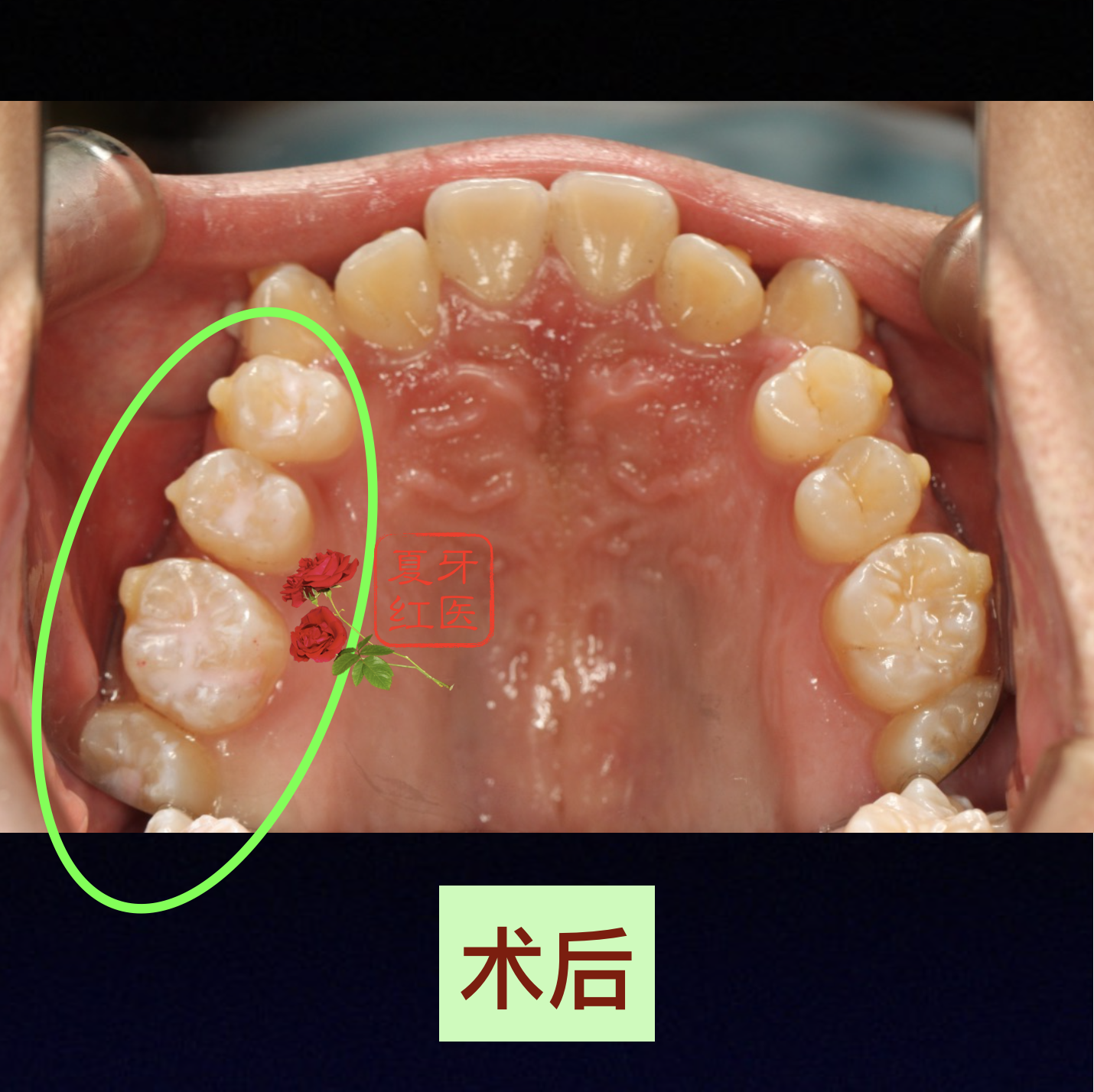 窩溝封閉為什麼對於年輕恆牙不可錯過