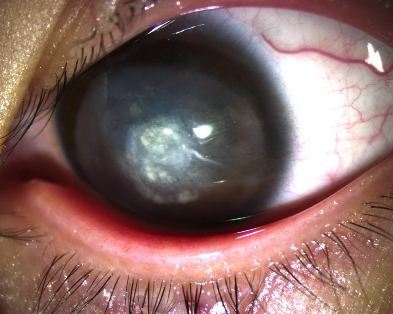 一个小女孩的10年追光路:两次失明,两次挽救成功 - 好大夫在线