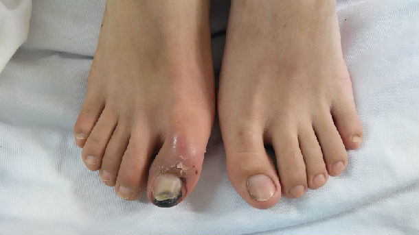 下肢动脉硬化闭塞,组织坏死期(足大趾干性坏疽1级)下肢动脉硬化闭塞