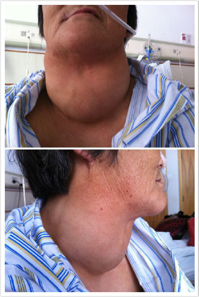 巨大结节性甲状腺肿goiter