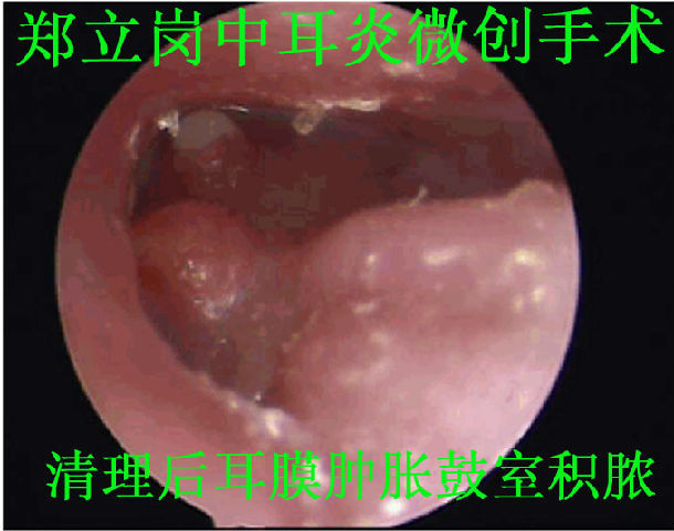 中耳乳突炎并周围性面瘫微创手术193回四川内