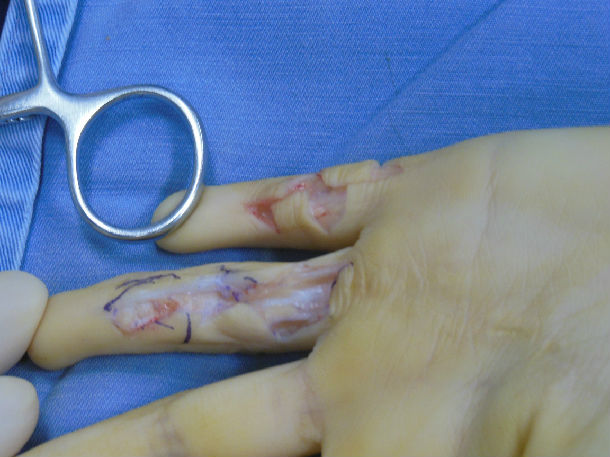 手指瘢痕畸形整形 