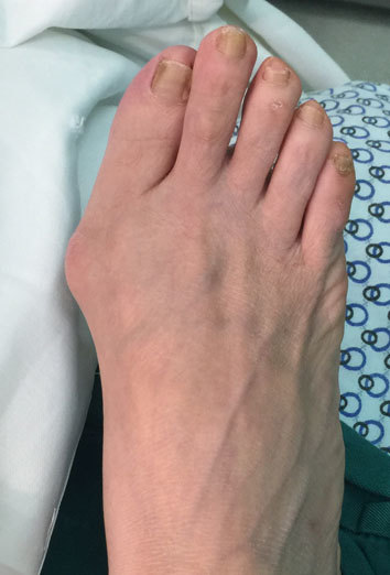 踇外翻畸形治疗及康复指南_先天性足畸形_先天性足畸形康复 - 好大夫