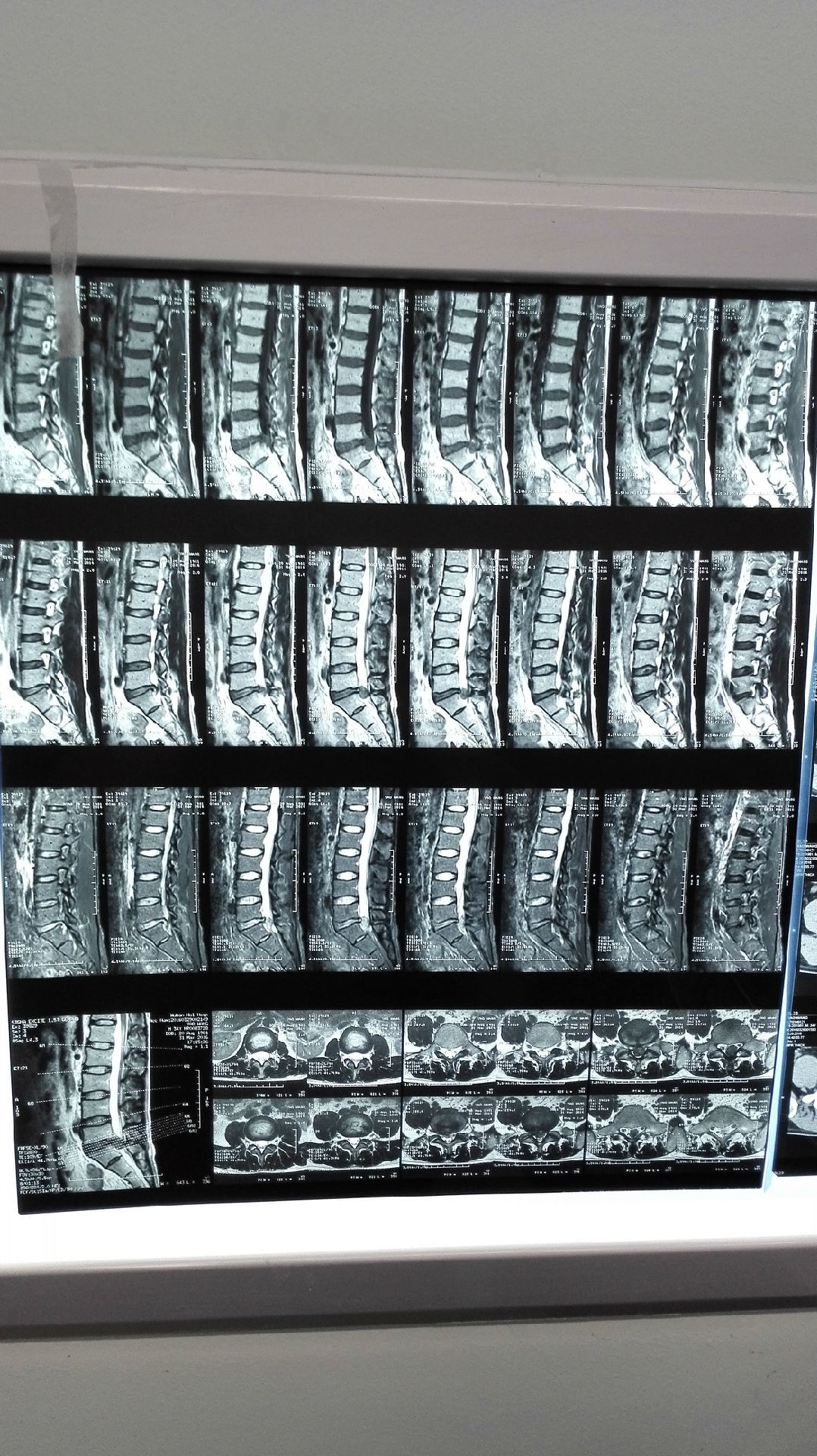 l5-s1巨大突出伴脱垂的椎间孔镜治疗(316) - 好大夫在线