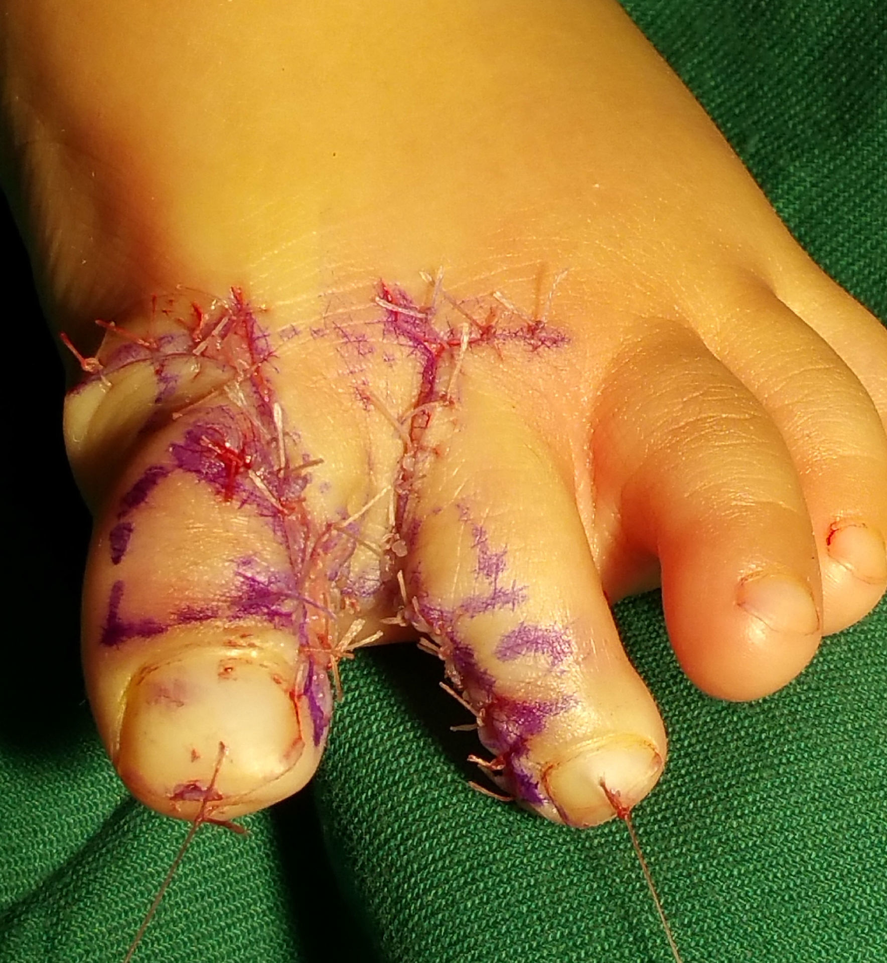 主要的治疗方法是手术,也就是分开并在一起的两个手指,手指分开后