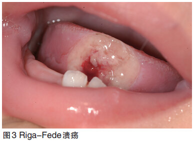 口腔溃疡久不治,转眼癌变悔终生!