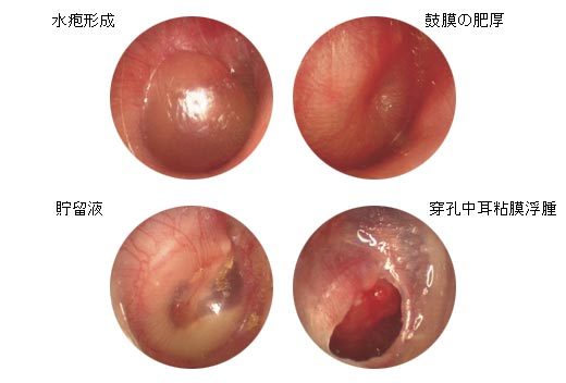 中耳炎鼓膜图