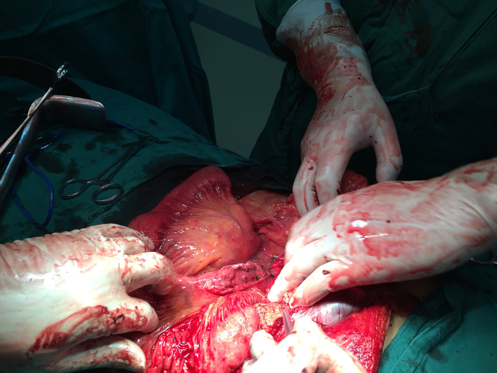 深夜救治车祸腹部损伤肠断裂