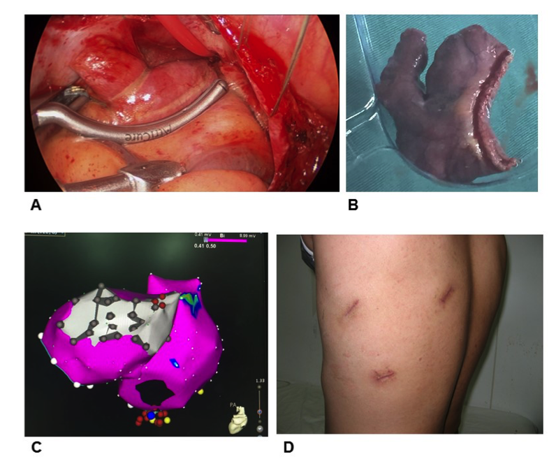 经胸腔镜行心房外膜消融;b:切除的左心耳;c:经导管介入方法行心房内膜