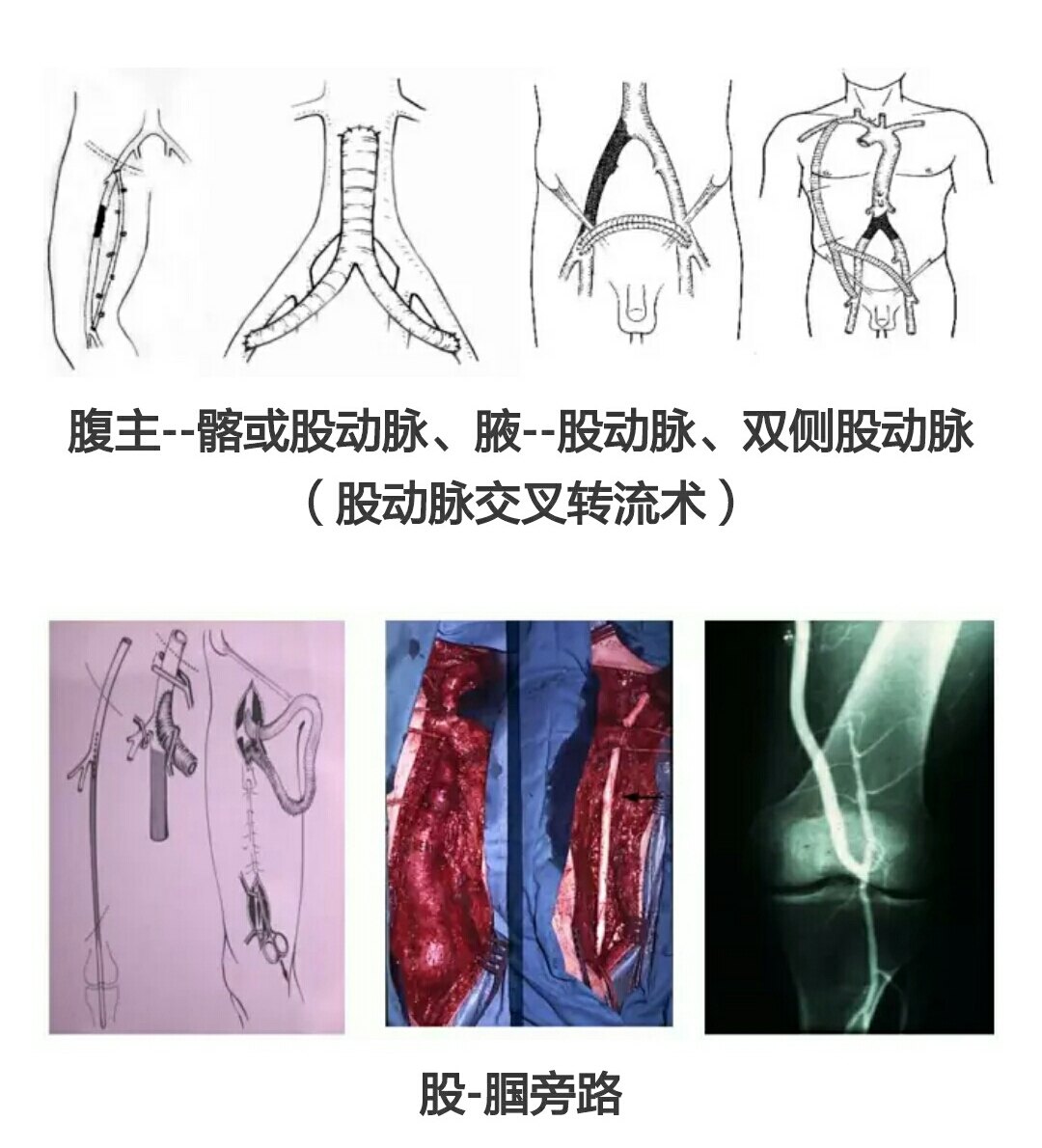 动脉硬化性闭塞症