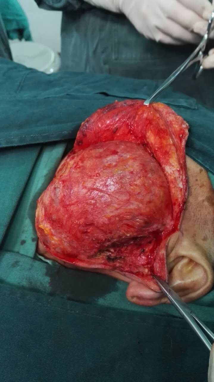 腮腺warthin瘤图片