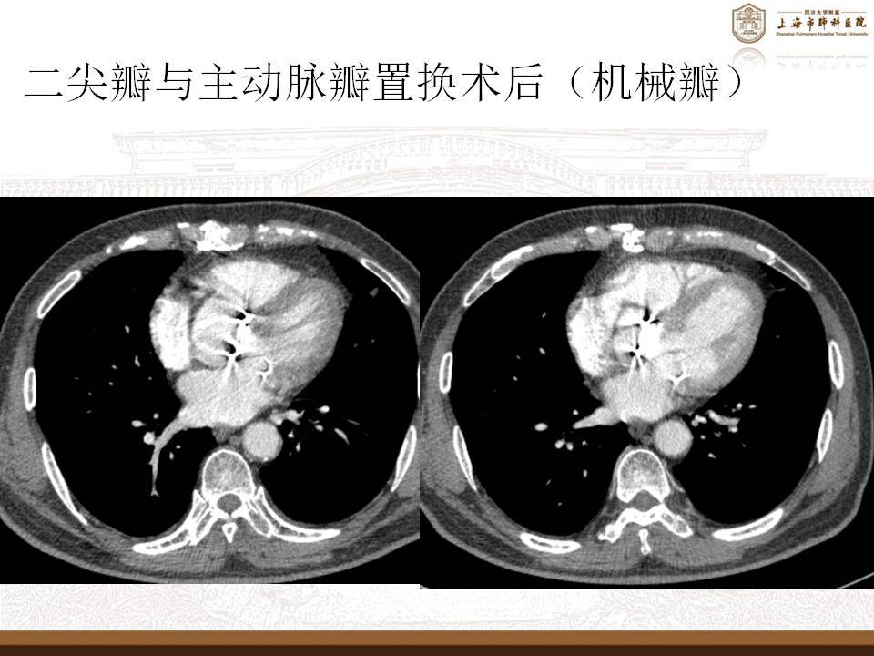 心臟冠脈瓣膜相關的ct表現