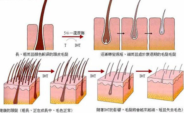 DHT引起秃发模式图.jpg