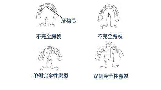 3,单侧完全性腭裂:裂隙自腭垂至切牙孔完全裂开,并斜向外侧直抵牙槽突