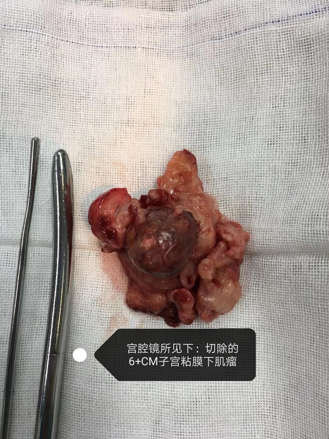 宫颈口粘膜下肌瘤图片图片