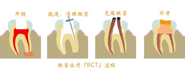 根管治疗.jpg