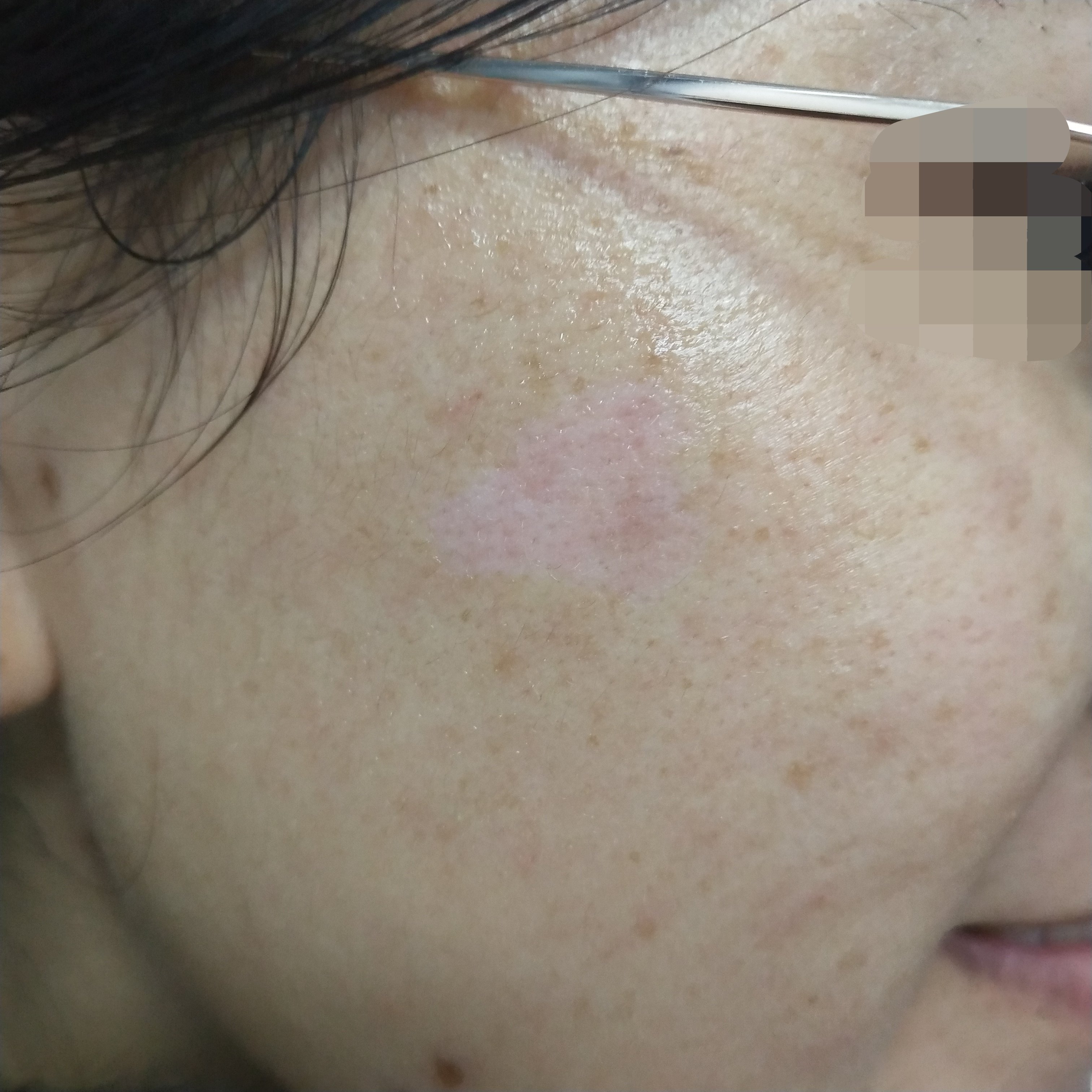 偏方治疗咖啡斑成功_老年斑的治疗小偏方_老年肺癌早期治疗偏方