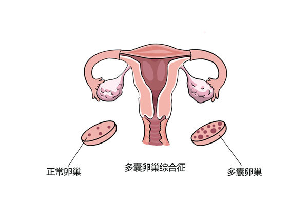 多囊卵巢卡通图片图片