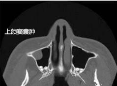 1575092433922607.jpg 上颌窦囊肿_副本.jpg