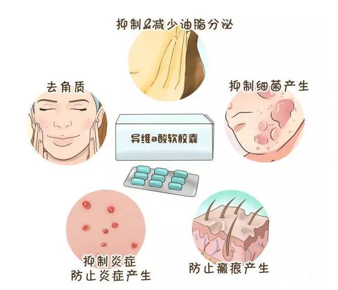 口服异维a酸胶丸副作用到底有多大?