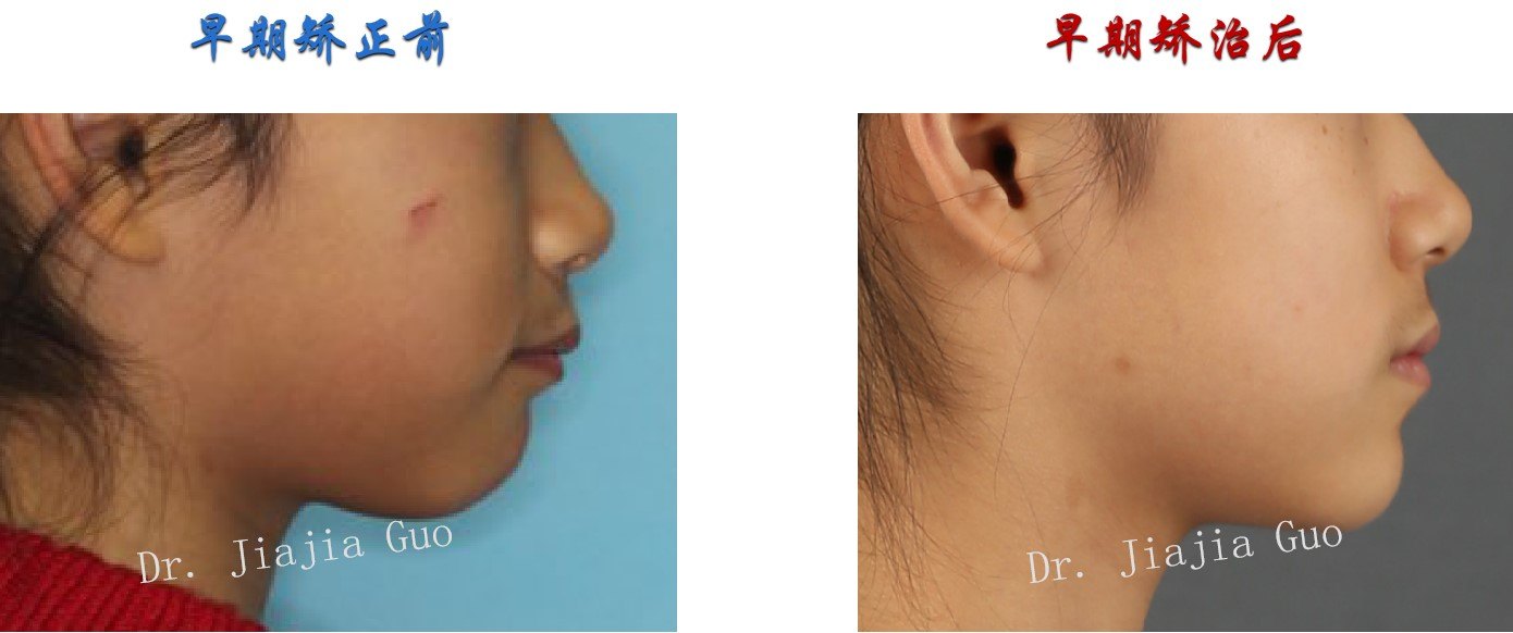 早期矫正案例9岁小姑娘上颌前突下颌后缩