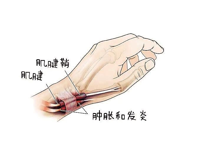 什麼是狹窄性腱鞘炎如何治療