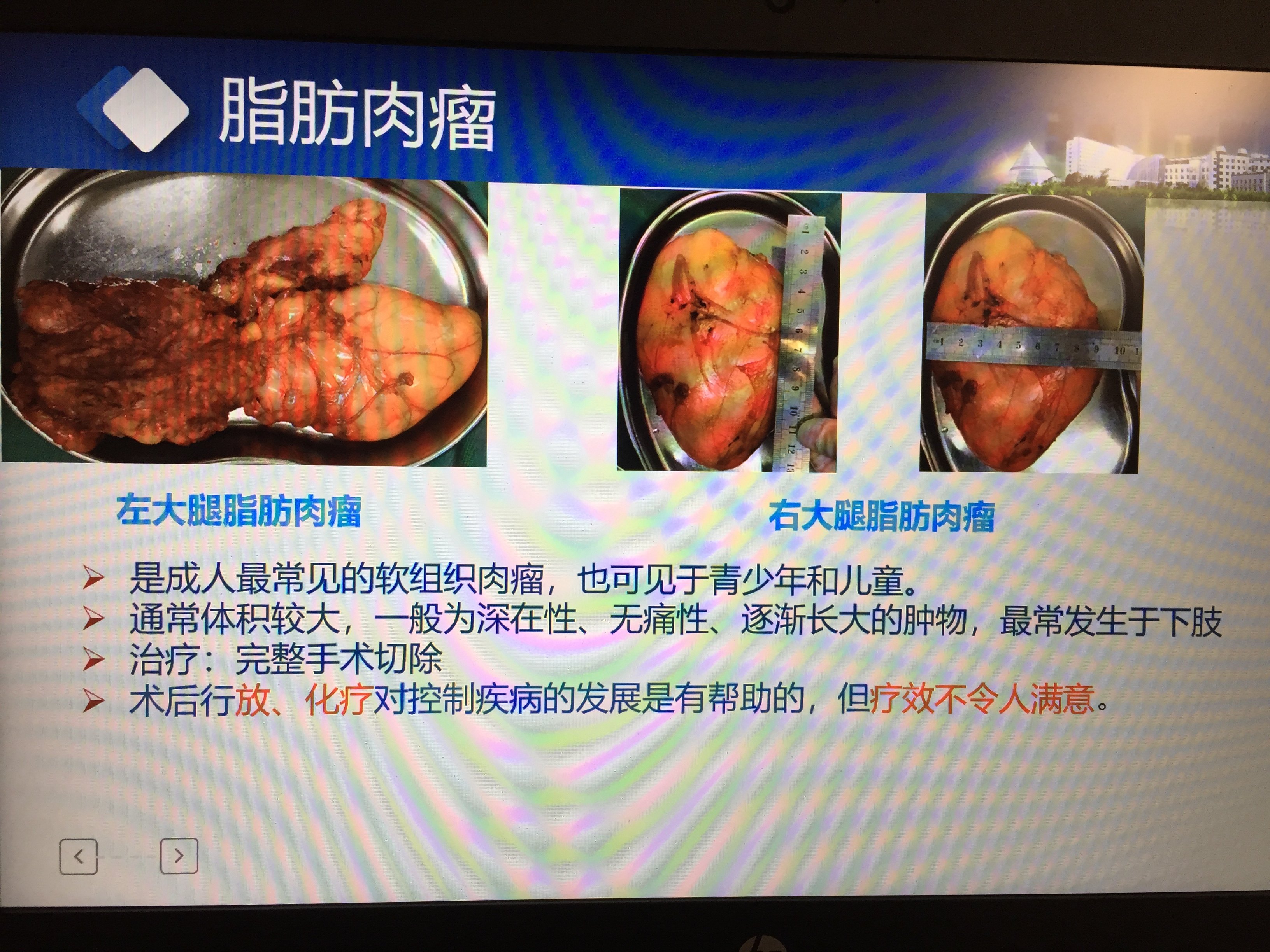 脂肪肉瘤相关科普 软组织肿瘤 软组织肿瘤 脂肪肉瘤相关科普 软组织肿瘤 软组织肿瘤