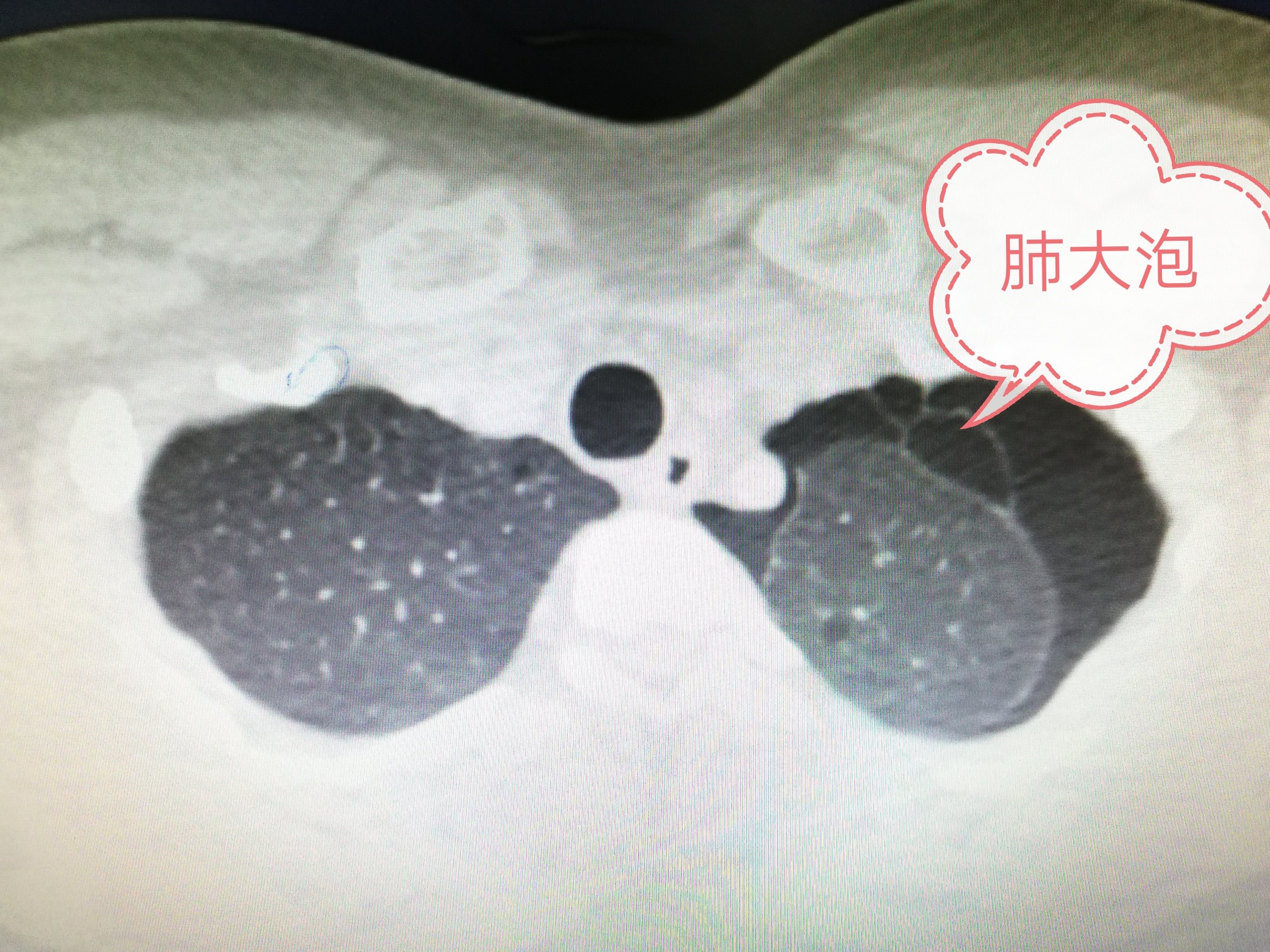 气胸 续篇 除了青年瘦高男性 年轻的女性也会得气胸 气胸