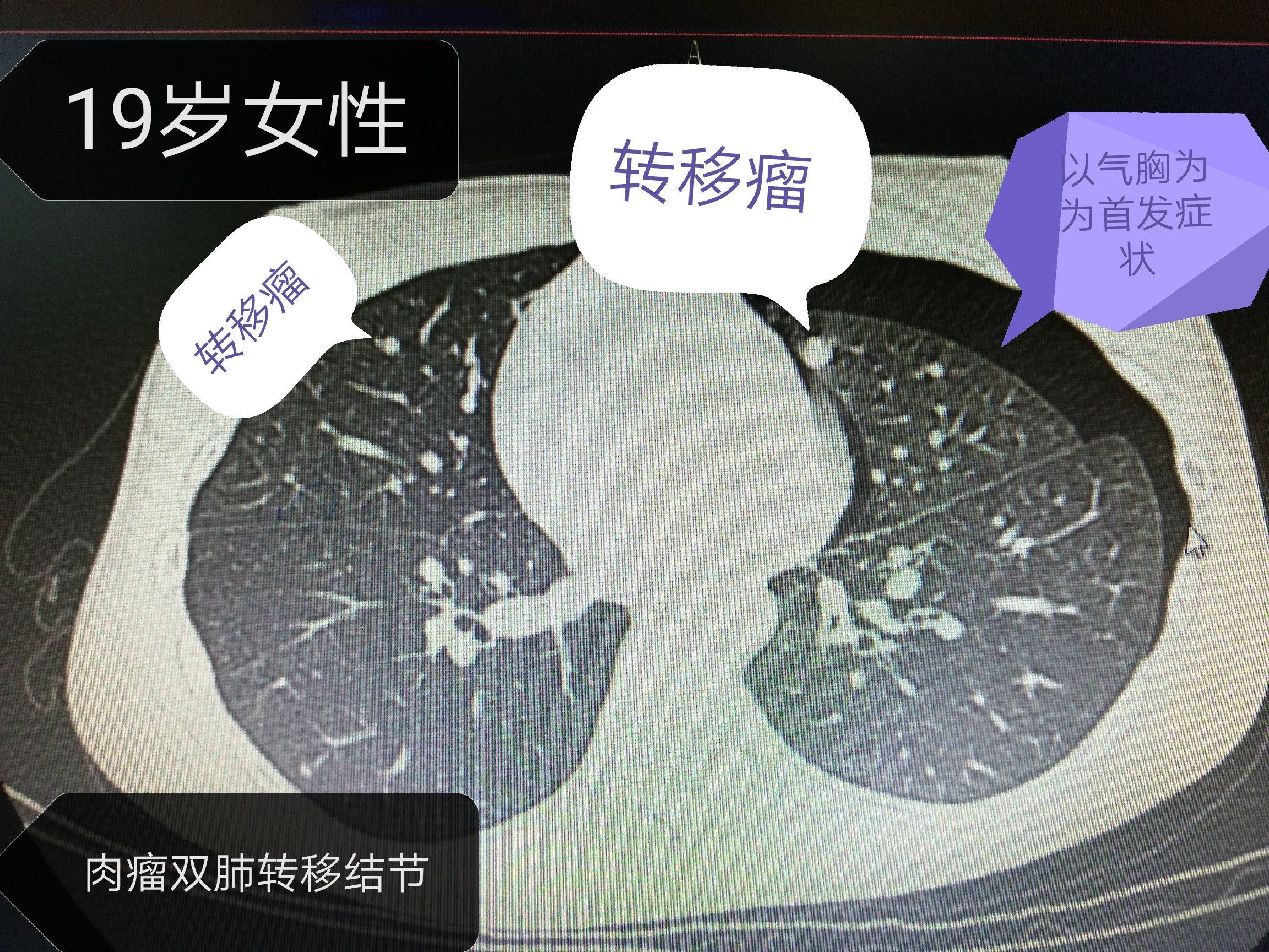 气胸（续篇），除了青年瘦高男性，年轻的女性也会得气胸！_气胸_介绍_发病原因_治疗方式 - 好大夫在线