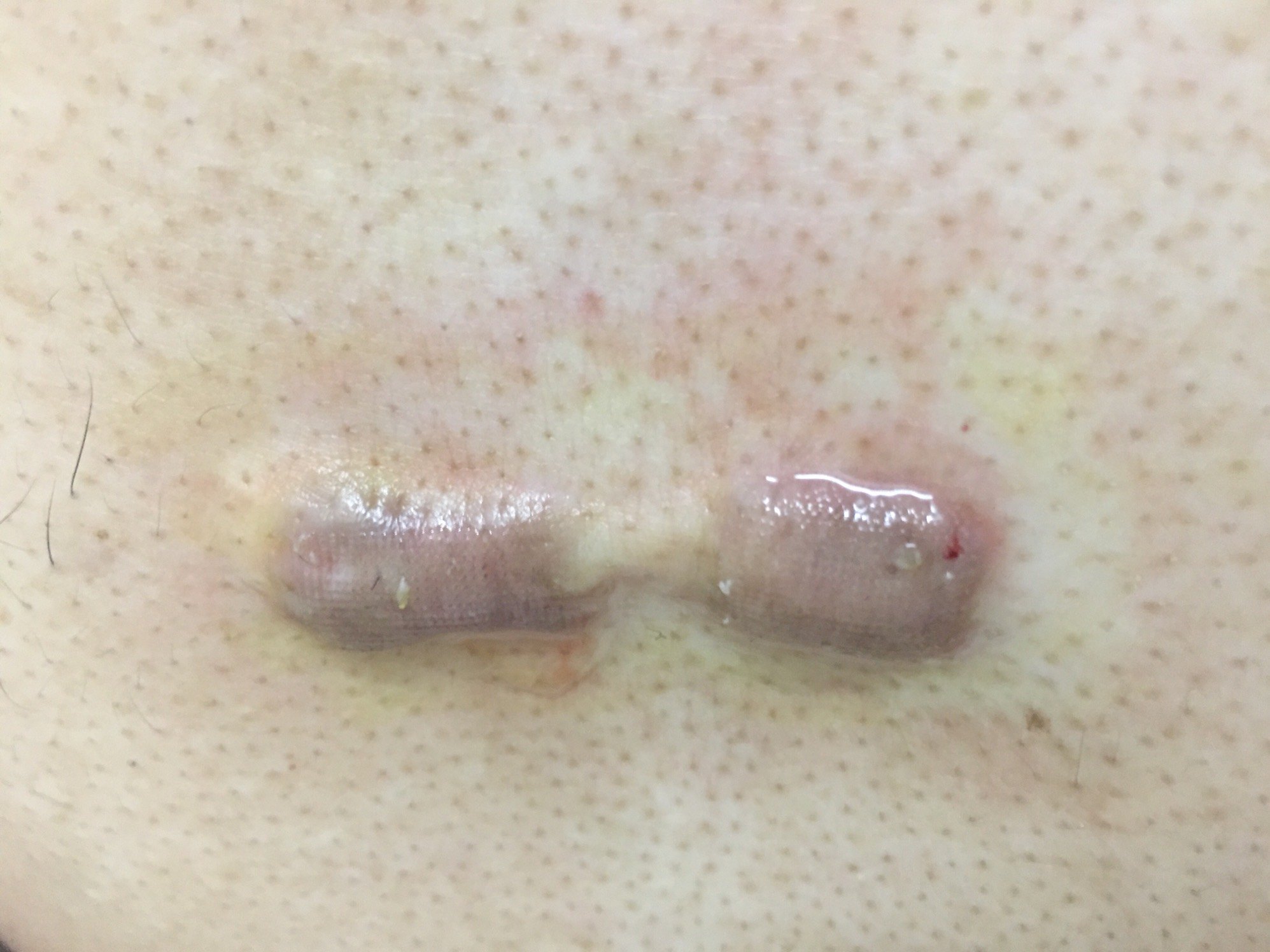 治疗瘢痕疙瘩常用的方法有以下几种:_瘢痕疙瘩_瘢痕疙瘩治疗方式 - 好