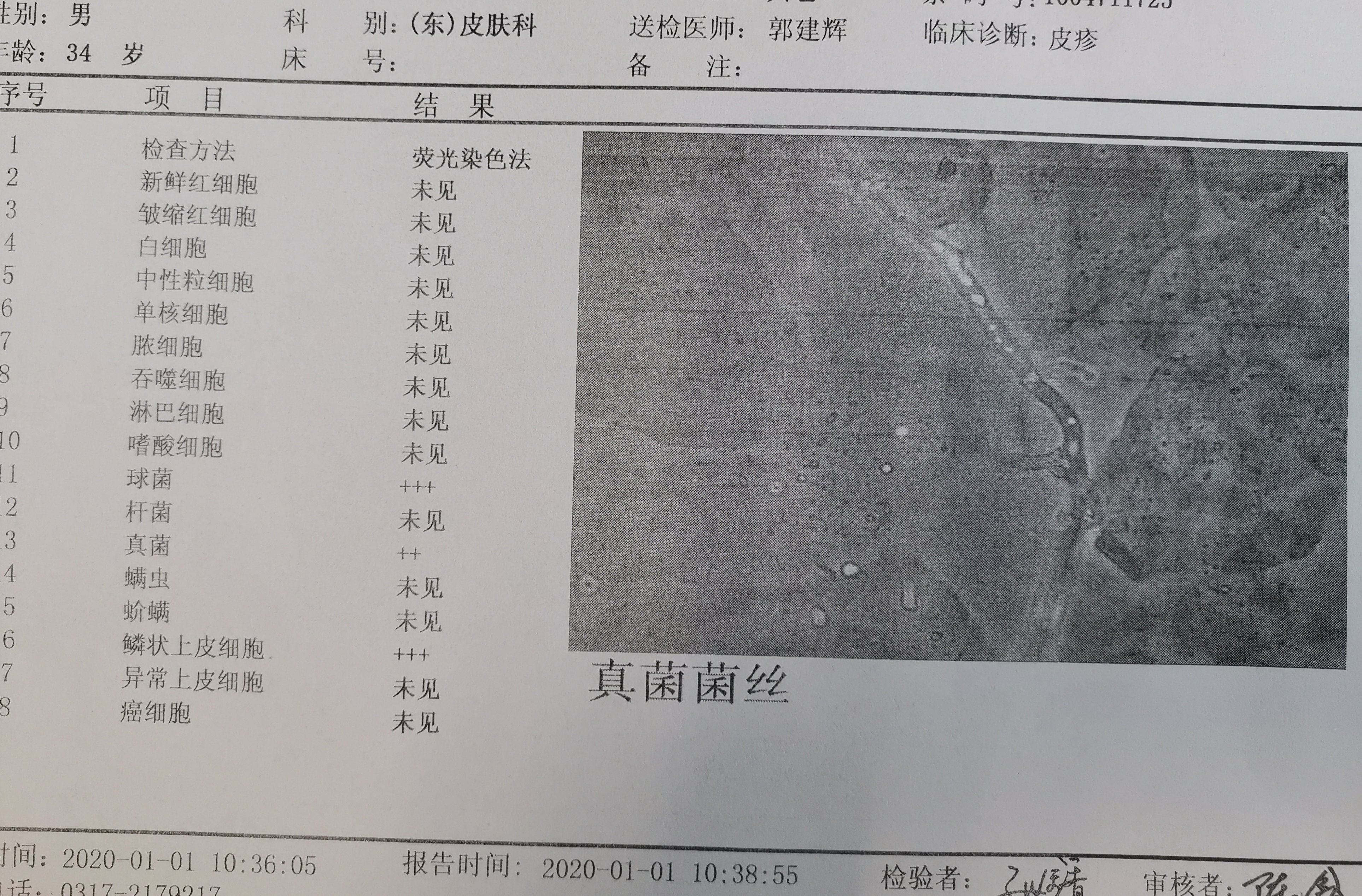 真菌镜检阳性,找到真菌菌丝.