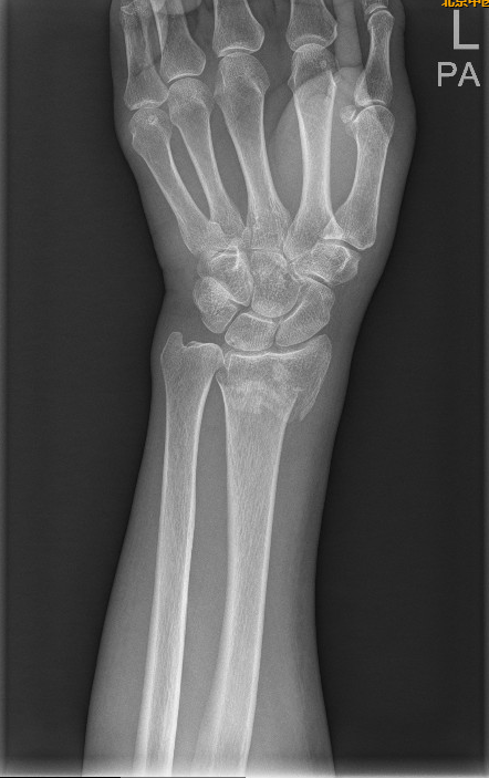 手右桡骨远端骨折图图片