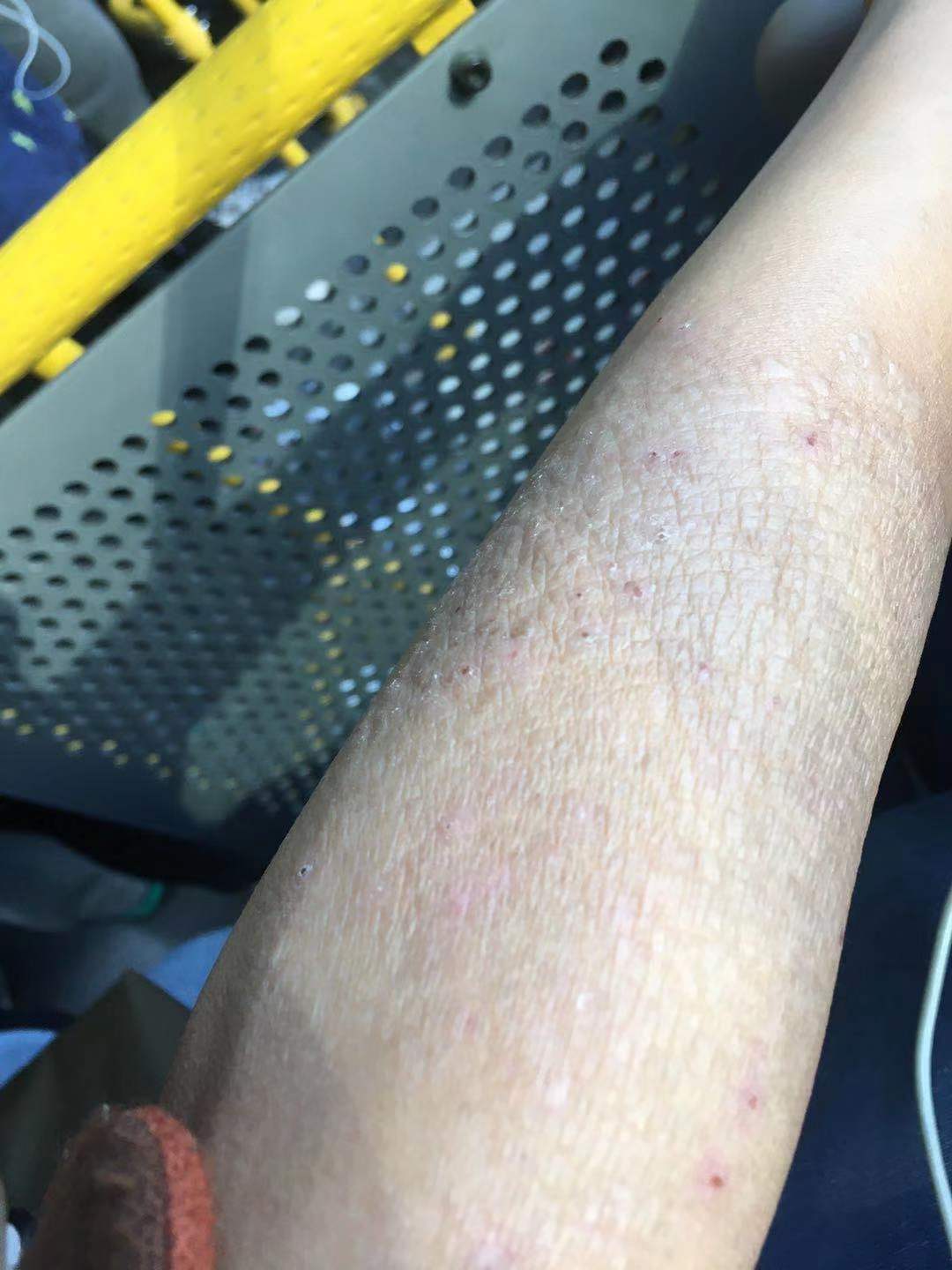 非药物治疗湿疹,神经性皮炎_湿疹_湿疹治疗方式 - 好大夫在线