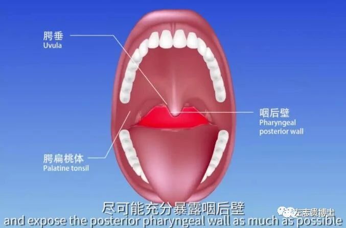 腭垂发炎吃什么图片