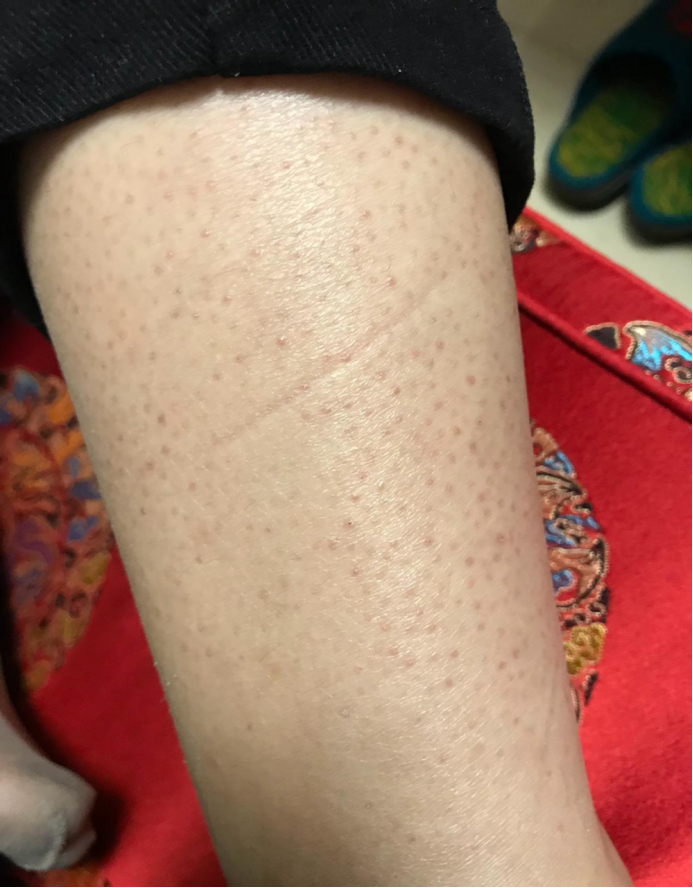 怎样治好鸡皮肤怎么(怎样治鸡皮肤怎么消除) 怎样治好鸡皮肤怎么(怎样治鸡皮肤怎么消除)