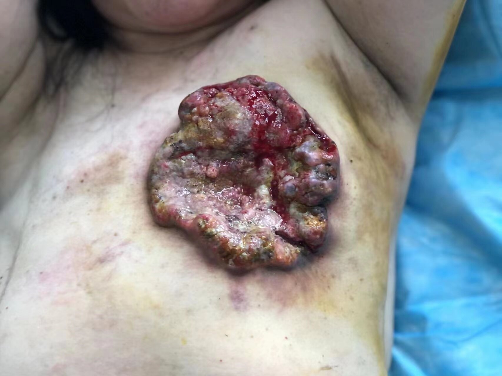 初步认识乳腺癌