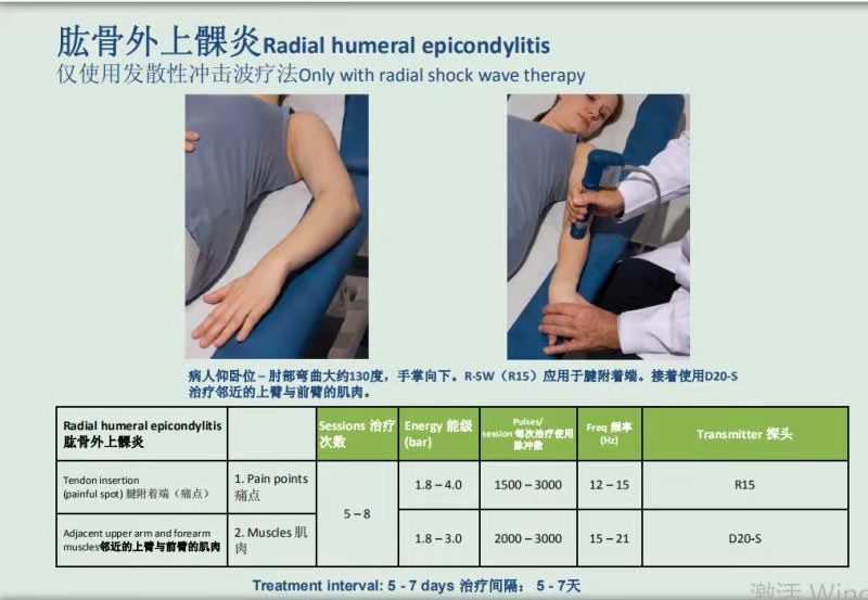 冲击波治疗学习之二——肱骨外上髁炎