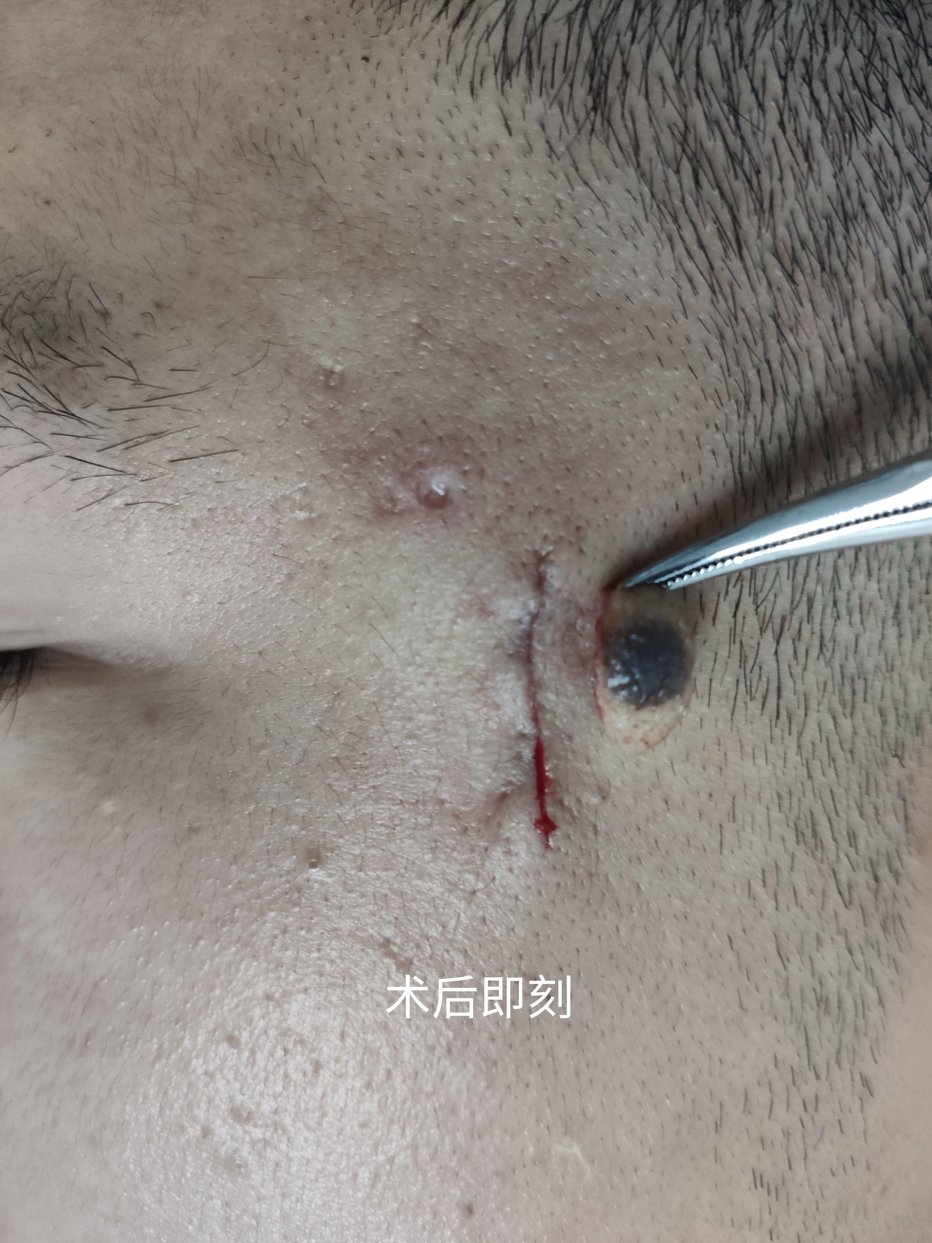 胳膊上的疤是什么疫苗6_胳膊上没有疫苗疤_胳膊上的疤是什么疫苗