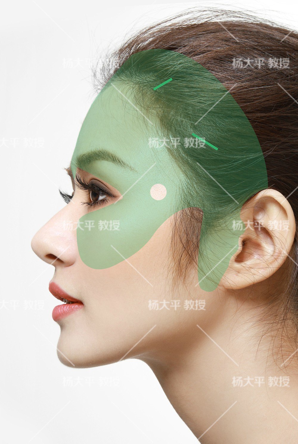 【"小马尾"提升术】更直接有效祛除印第安纹的手术方式_微整形除皱