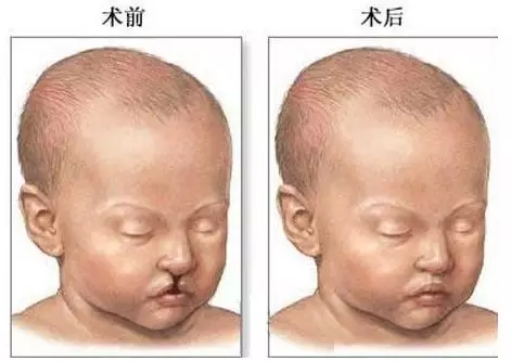 唇腭裂的序列治疗