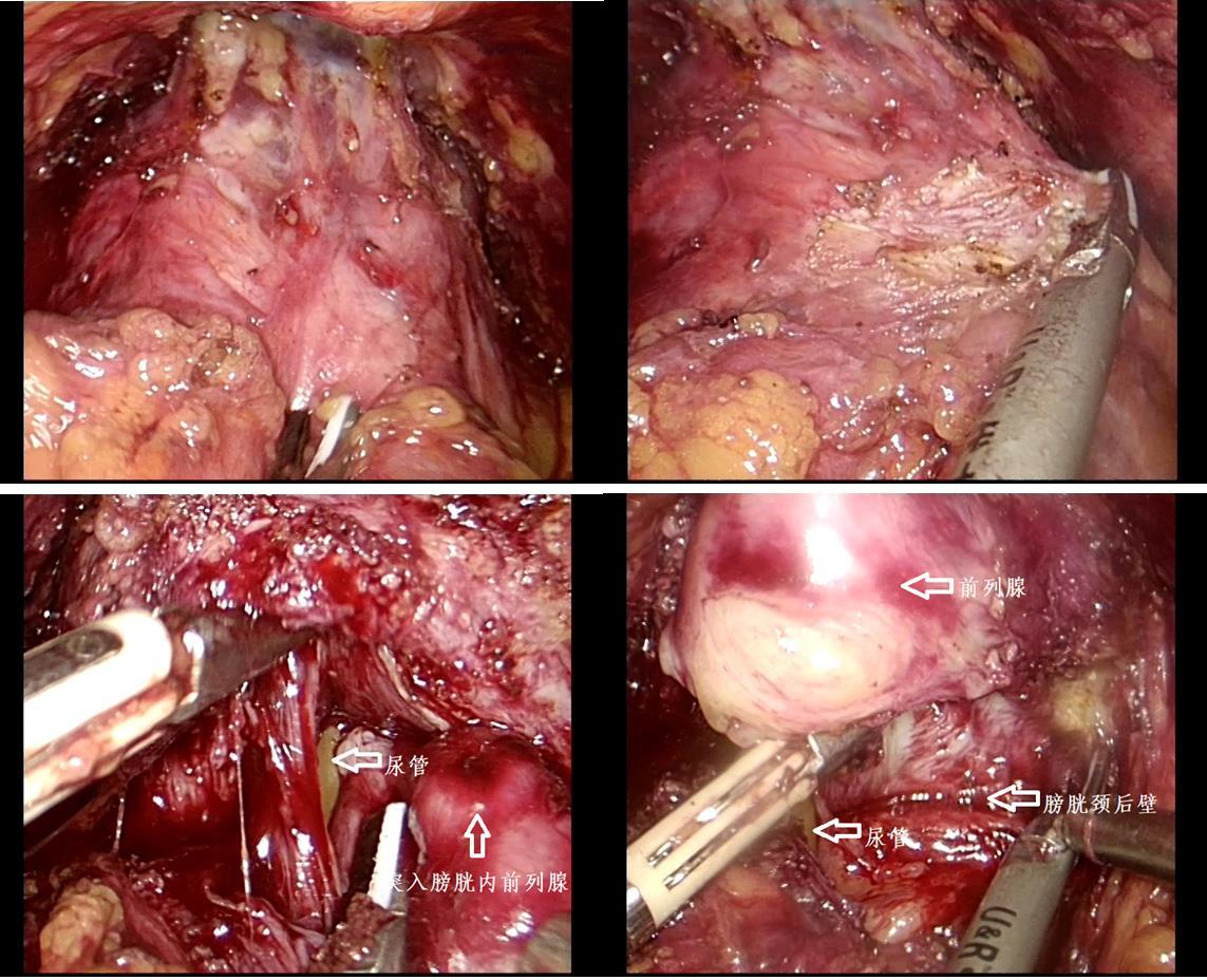 顯露膀胱頸部;離斷膀胱頸前壁,暴露膀胱頸後壁並離斷;4,充分遊離前列