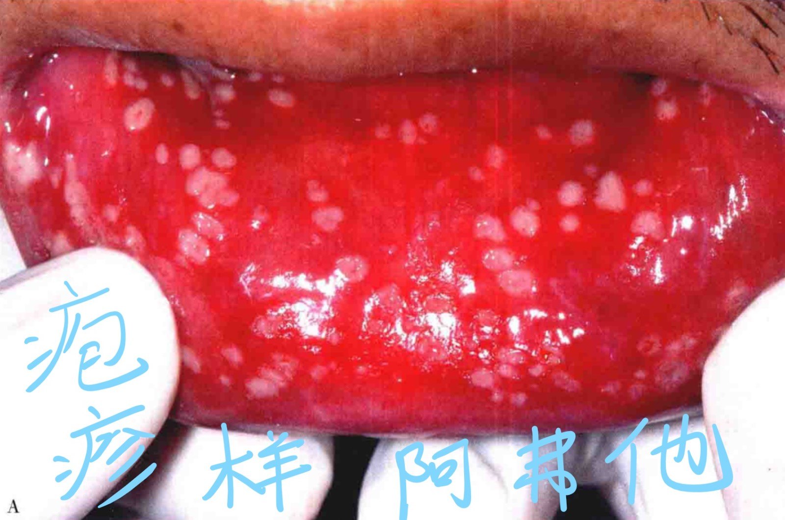 口腔溃疡——复发性阿弗他溃疡及腺周口疮和白塞氏病的图文介绍 