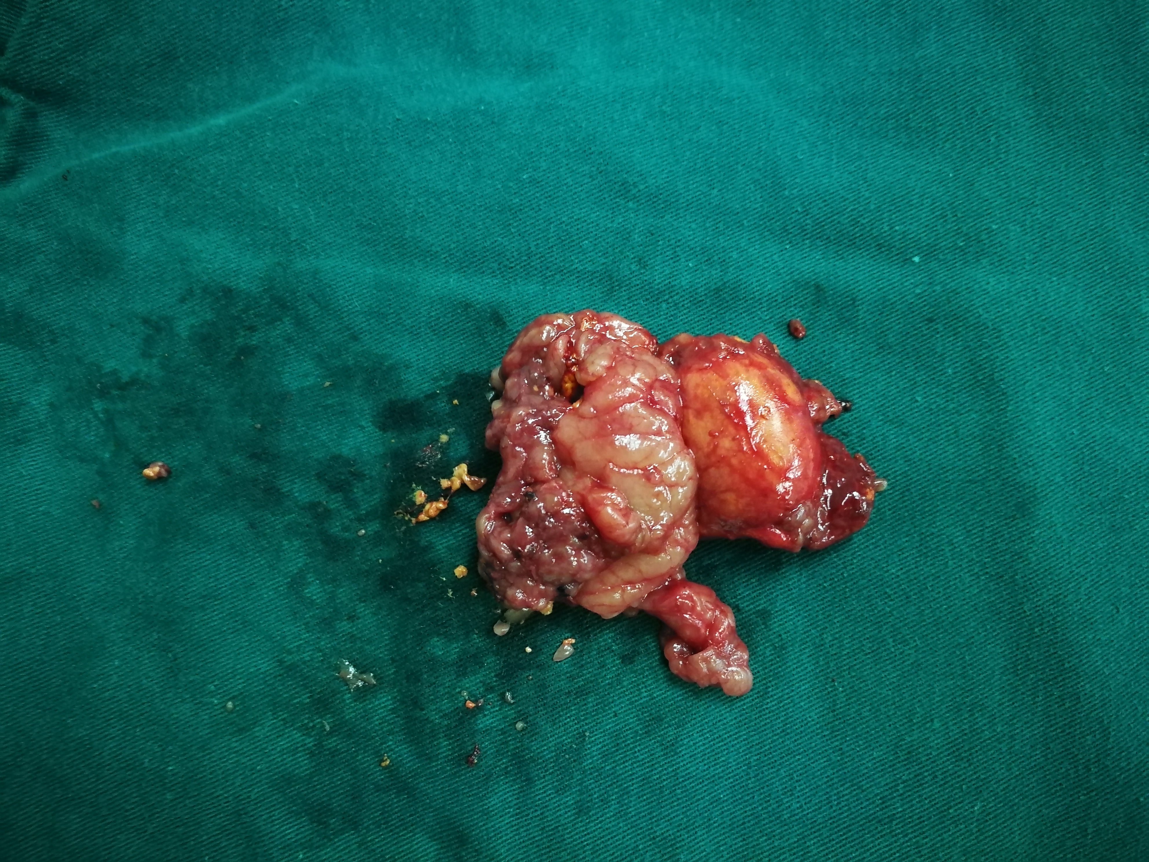 腹腔癌图片