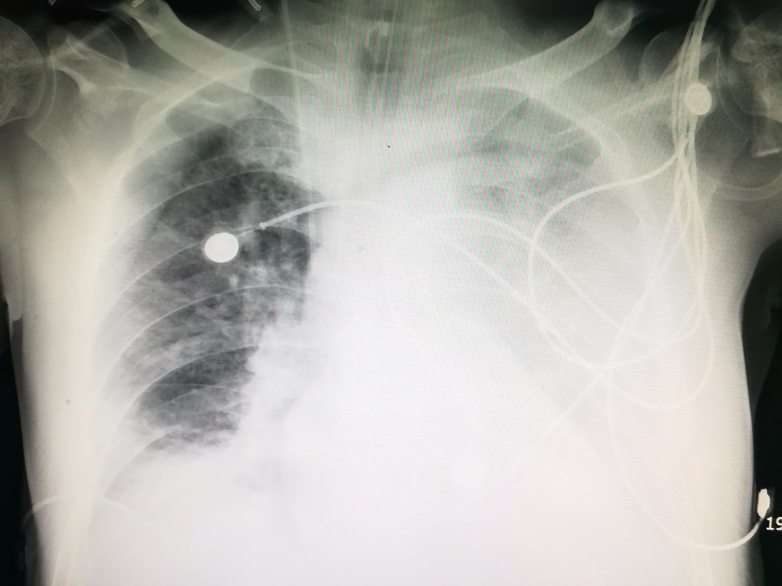 术后胸片显示双肺不张大量胸水jpg